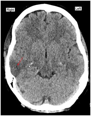 Case report: A comatose patient with pregabalin overdose successfully treated with continuous renal replacement therapy